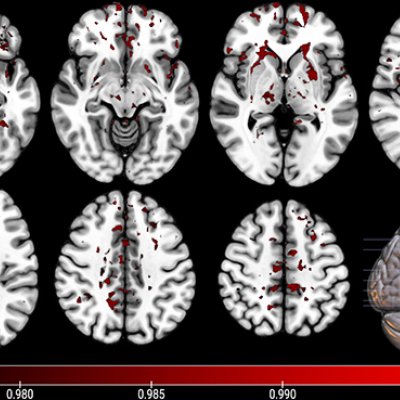 a series of black and white images of sections of a brain with red patches